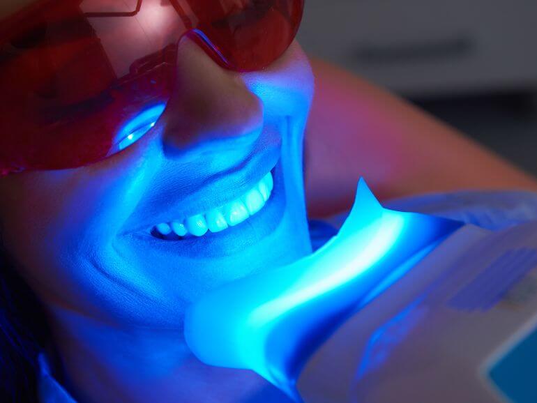 sbiancamento dentale mestre venezia